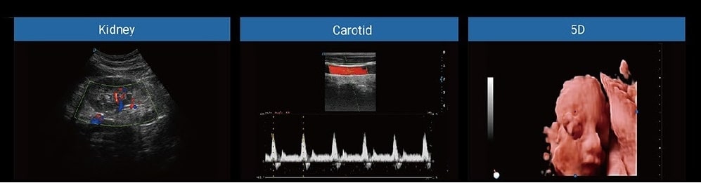 OBGYN Recommended Color Doppler Ultrasound Machine-MS-U50 6 Color doppler ultrasound images2-MS-U50